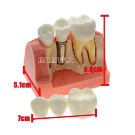 〇歯科模型 歯列模型 インプラント　ブリッジ