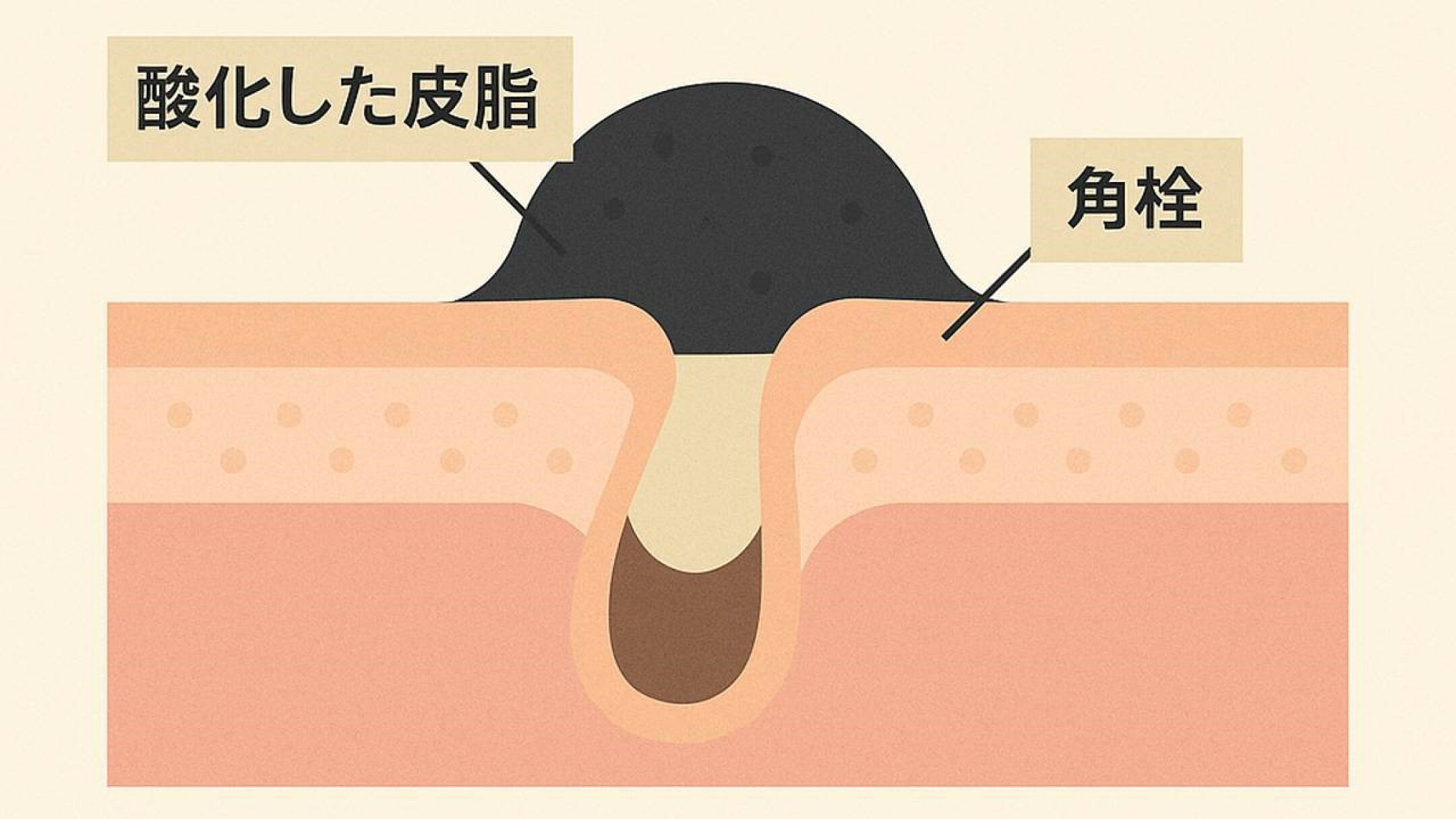 黒ずみの原因は毛穴につまった皮脂や角質の酸化です。