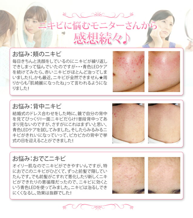 楽天市場 ニキビケア専用 美顔器 美ルル For アクネ ニキビ ケア アクネ菌 光エステ 青色led 美肌 美顔機 送料無料 海外使用可 返品保証 Belulu For Acne Ange Beaute