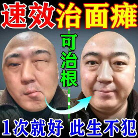 フェイスベルト リフトアップ バンド 顔面 麻痺 歪み 後遺症 回復 筋 けいれん トレーニング