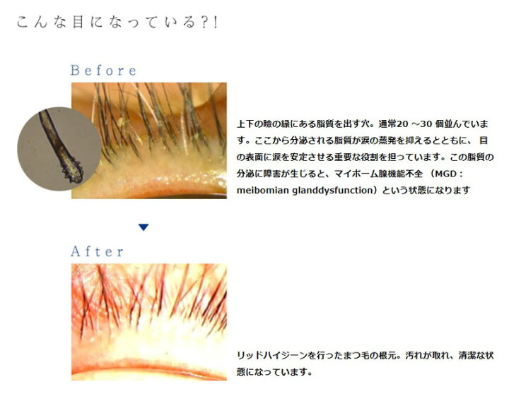 アイシャンプー ロング まつ毛シャンプー 60ml しみない マイポーム腺炎防止 マイボーム腺梗塞 リッドハイジーン◇ ベリーズコスメ マイボーム腺シャンプー