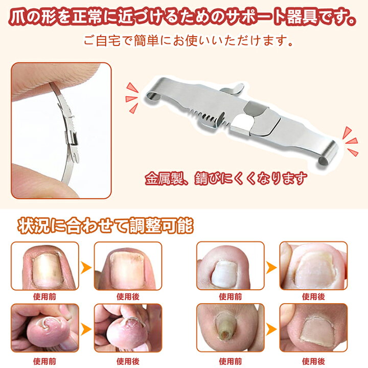 楽天市場】巻き爪 矯正 セット サポート 器具（ケース付き 