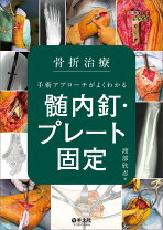 楽天市場】骨折プレート治療マイスターの通販