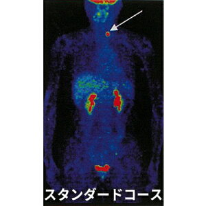 yӂ邳Ɣ[ŁzP2 X^_[hR[X PET-CT ᇃ}[J[ 񌟐f XN[jO t ̉ ޏk݉ ǌ Ȃ  m  