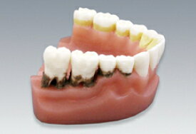 歯周疾患と歯磨き指導模型(下顎のみ・2倍大) 松風