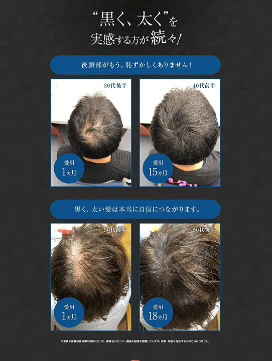 楽天市場】グロキシル ヘアトニック 【まとめ買い 28％OFF】育毛剤 