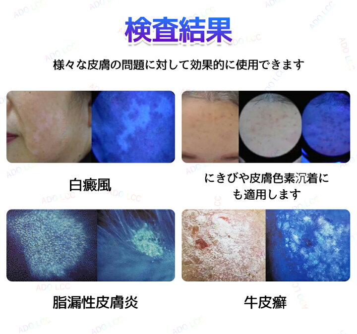 楽天市場】スキンチェッカー ウッドランプ 肌分析 LED紫外線灯 365nm 