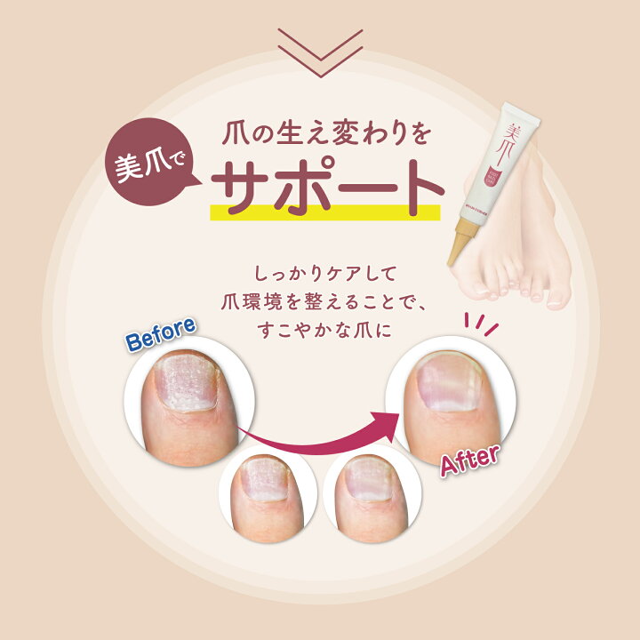 楽天市場 送料無料 美爪 15g 足爪用ネイルケアジェル 塗るだけケアで美しく健康な爪環境へ 美爪 ネイルケア 補強 割れ 補修 ネイル ケアセット 保護 オイル 縦線 足の爪 日本製 爪ケア フットネイル 足爪きれい 爪 ボコボコ 爪でこぼこ 親指 乾癬 足の爪 足爪 黒い線