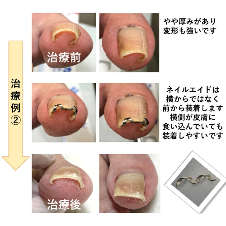 巻き爪  矯正 10枚セット