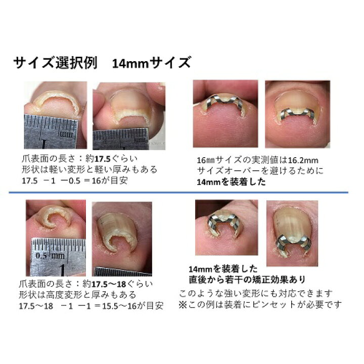 楽天市場 追加購入専用 14mm 巻き爪 自分で 巻き爪矯正 ネイル エイド クリップ ワイヤー ガード 爪ブロック 切り方 テープ ロボ 巻きづめ 靴 巻爪 対策 14mm ピンセット説明書なし クーポンで100円割引 巻き爪 陥入爪治療の相談室