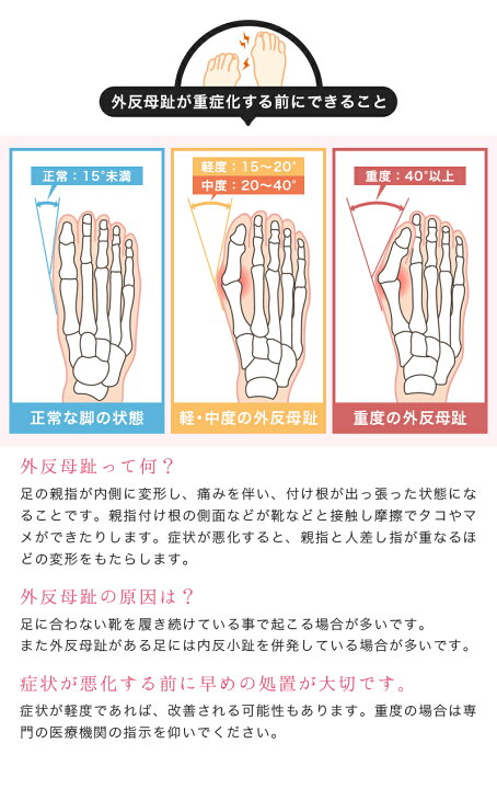 市場】外反母趾 サポーター シリコン 両足セット 対策 フットケア 足 親指 曲がり パット 足の痛み サポート 旅行 子供 大人 運動 足 のゆがみ【meru1】 : HOMMALAB市場店 市場】外反母趾 サポーター シリコン 両足セット 対策 フットケア 足 親指 曲がり パット 足の痛み サポート 旅行 子供 大人 運動 足 のゆがみ【meru1】 : HOMMALAB市場店