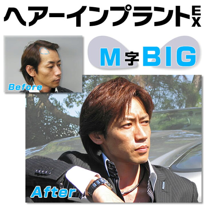 楽天市場】ヘアーインプラントEX M字用BIG(男性用かつら)※強力テープ 