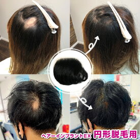 ヘアーインプラントEX円形脱毛症用　円形脱毛 隠す　※装着にはテープかシリコンが必要です