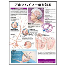 ポスター アルツハイマー病を知る 人体解剖図 医学ポスター 医学チャート 脳の老化 認知症 脳細胞構造の異常 神経原線維変化 老人斑 大脳皮質変化 神経伝達物質 アルツハイマー病の進行と対応 アルツハイマー病介護要点