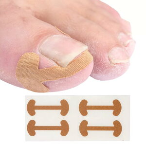 陥入 爪 矯正器粘着ワイヤー足の親指 爪 囲炎治療修復剤外反母趾矯正器 ペディキュア ネイル ケア ツール