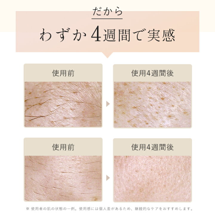 楽天市場】【お買い物マラソンはP20倍でお得☆】楽天1位☆IPL光美容器 
