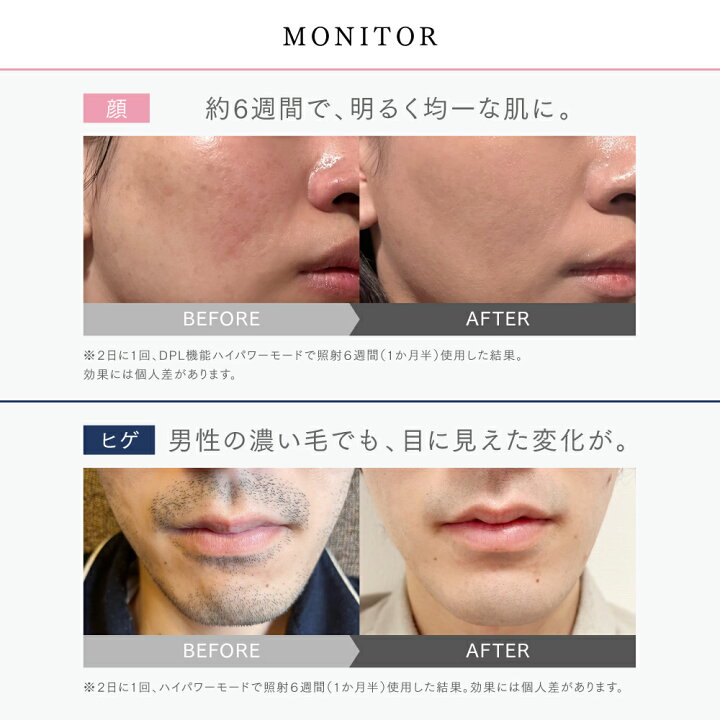 楽天市場】【公式｜マラソン限定 先着100名→51,040円】脱毛器 