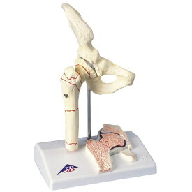 大腿骨骨折解説模型（1／2） A88 1台 日本スリービー・サイエンティフィック 11-2830-00