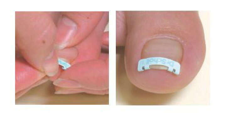 楽天市場】Dr.Scholl(ドクターショール) 巻き爪用クリップ Sサイズ 14.5mm 1個【返品不可】 : MeReCare-y(メリケア)楽天市場店 楽天市場】Dr.Scholl(ドクターショール) 巻き爪用クリップ Sサイズ 14.5mm 1個【返品不可】 : MeReCare-y(メリケア)楽天市場店