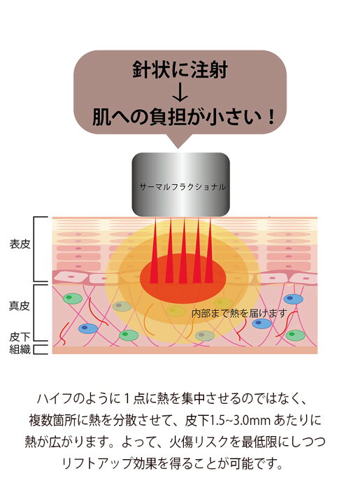 楽天市場】サーマルフラクショナル【1年保証】RF美顔器 サーマル  