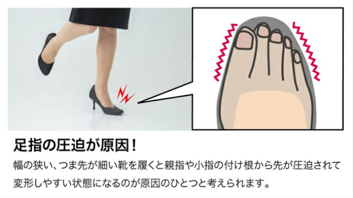 楽天市場 外反母趾 内反小趾 サポーター 足指 広げる 外反母趾サポーター 内反小趾サポーター 矯正 外反母指 外反拇指 矯正グッズ 矯正サポーター 浮き指 モートン 小指 ストレッチ Makuake クラウドファンディング 外反母趾おやすみサポーター お買い物マラソン 送料
