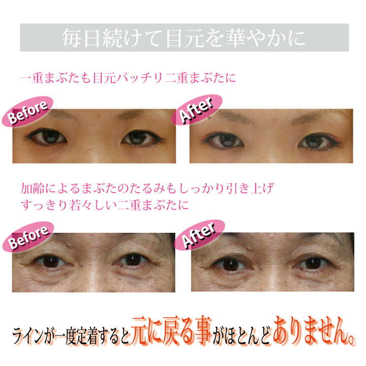 楽天市場 12 26 1 59まで 最大00円offクーポン クーポンの取得 送料無料 アイプチ 二重 癖付け 二重まぶた 二重瞼 まぶた たるみ アイテープ 二重のり 一重 奥二重 プチ整形 矯正 形成 くっきり ぱっちり 目 瞳 二重まぶた形成器 Omni オムニ Newアイリッド 楽天市場 12 26 1 59まで 最大00円offクーポン クーポンの取得 送料無料 アイプチ 二重 癖付け 二重まぶた 二重瞼 まぶた たるみ アイテープ 二重のり 一重 奥二重 プチ整形 矯正 形成 くっきり ぱっちり 目 瞳 二重まぶた形成器 Omni オムニ Newアイリッド