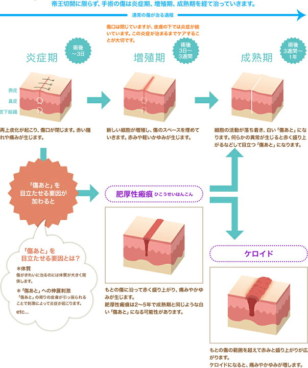 楽天市場 アトファイン ニチバン 帝王切開の傷 手術後 傷 傷あと 保護 ケアテープ 日本製 メール便 送料無料 パーレン 楽天市場店