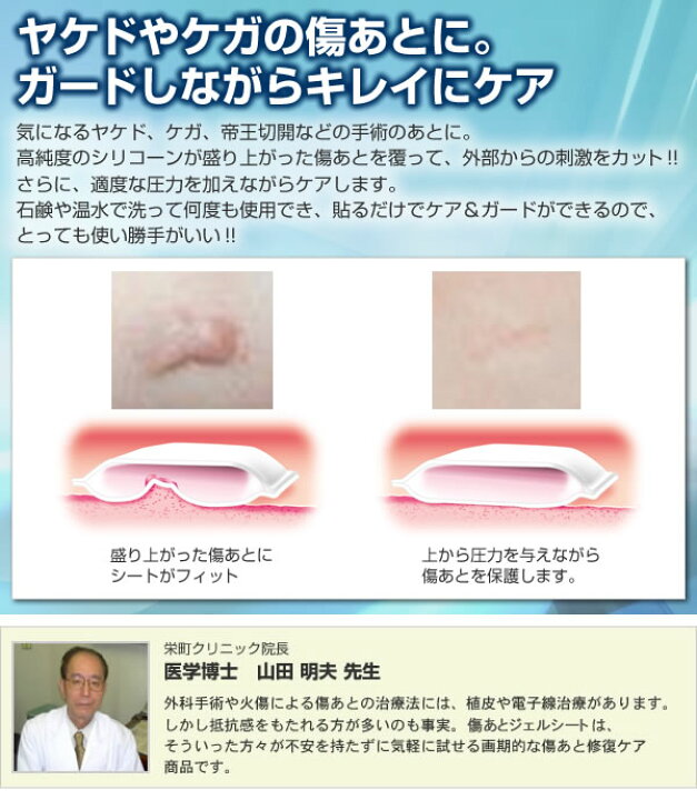 楽天市場】【ポイント10倍】【クーポンあり】【メール便対応】【送料無料】傷跡 やけど 手術痕 プリマ傷あとジェルシート : プロフィット楽天市場店 楽天市場】【ポイント10倍】【クーポンあり】【メール便対応】【送料無料】傷跡 やけど 手術痕 プリマ傷あとジェルシート : プロフィット楽天市場店