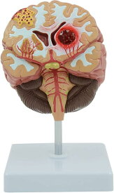医療解剖学教育モデルおよびツール 医療モデル 解剖学研究および教育に使用されるシミュレーション モデル 人間の脳の解剖モデル 脳出血 動脈 脳動静脈奇形 脳病理 脳教育補助具