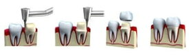 Getting A Dental Crown Procedure【電子書籍】[ James Messing ]