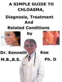 A Simple Guide to Chloasma, Diagnosis, Treatment and Related Conditions【電子書籍】[ Kenneth Kee ]