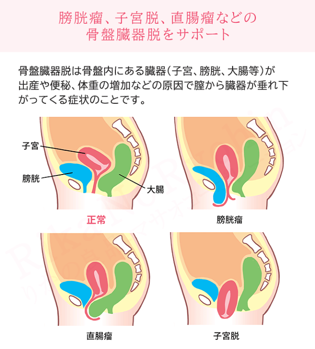 おわゆい　骨盤臓器脱サポーター　 テイキン 骨盤臓器脱サポーター メディカル・テイキン＜L〜LL S〜M＞ : は