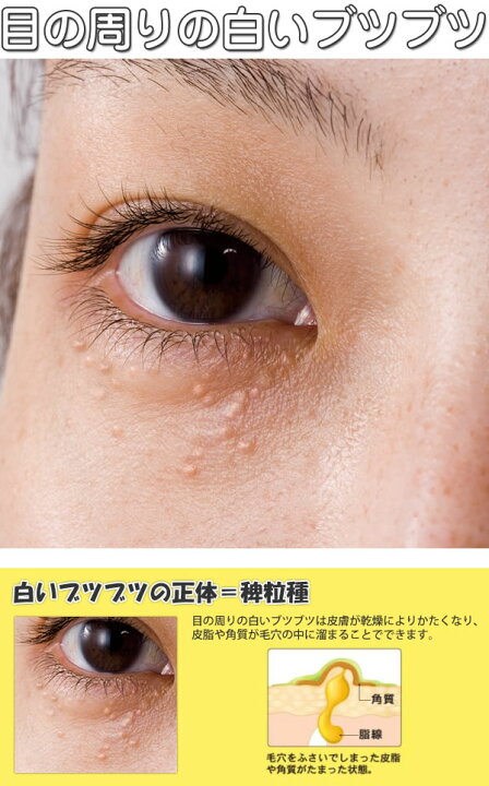 楽天市場 ビューナ シロポロン ケアクリーム 11g ぶつぶつケア 肌ケア 目の周り 白いブツブツ 白イボ 稗粒腫 送料無料 Sanana Store 楽天市場店