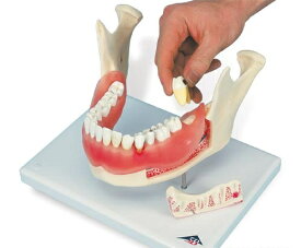 【送料無料】【無料健康相談 対象製品】3B社　歯・口腔模型 歯と歯茎の疾患モデル (d26)