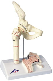 大腿骨骨折モデル A88