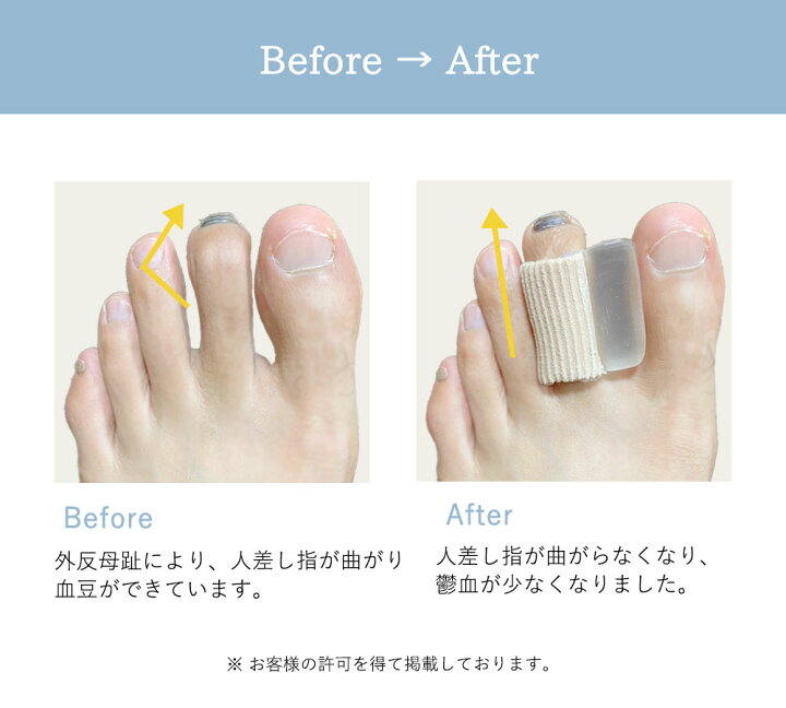 楽天市場 No22 きめ細やかさが売りのサックの内と外にもシリコンあんで 人差し指サックシリコン極致 楽天ランキング1位 子供から大人まで使える 外反母趾 足指矯正 サポータ グッズ 2個セット 外反母趾専門本舗