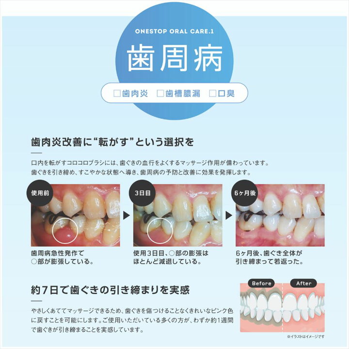 楽天市場 送料無料 歯ブラシ ローラー型 コロコロ歯ブラシ ピンク イエロー ブルー グリーン グレー ころころ歯ブラシ 歯科医がうなる歯ブラシ 歯ブラシ 歯科医 歯医者 歯垢除去 オーラルケア 歯の表面 歯間 歯ぐき 舌ブラシ はぶらし 歯茎 歯 大人 歯石 除去
