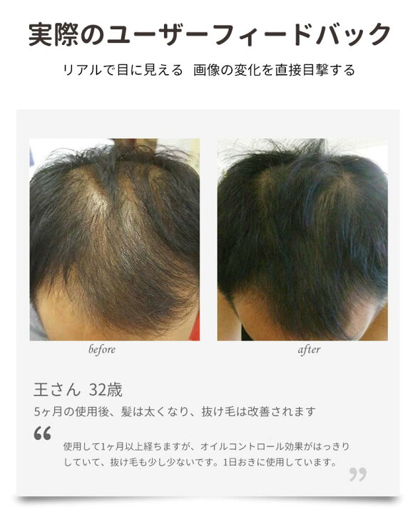 楽天市場】育毛ヘルメット 育毛キャップ 治療ライト レーザー育毛 