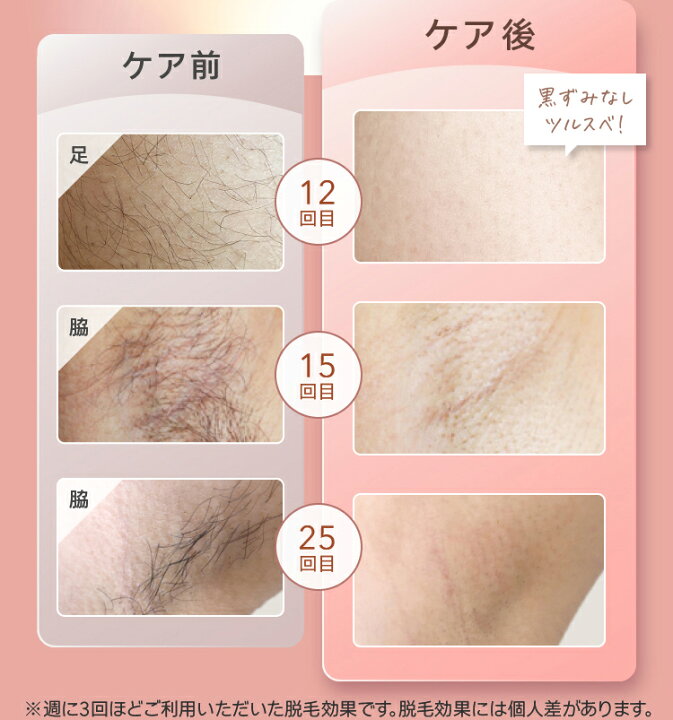 楽天市場】脱毛器 Ulike 公式 IPL 光脱毛器 Air 家庭用脱毛器 メンズ 