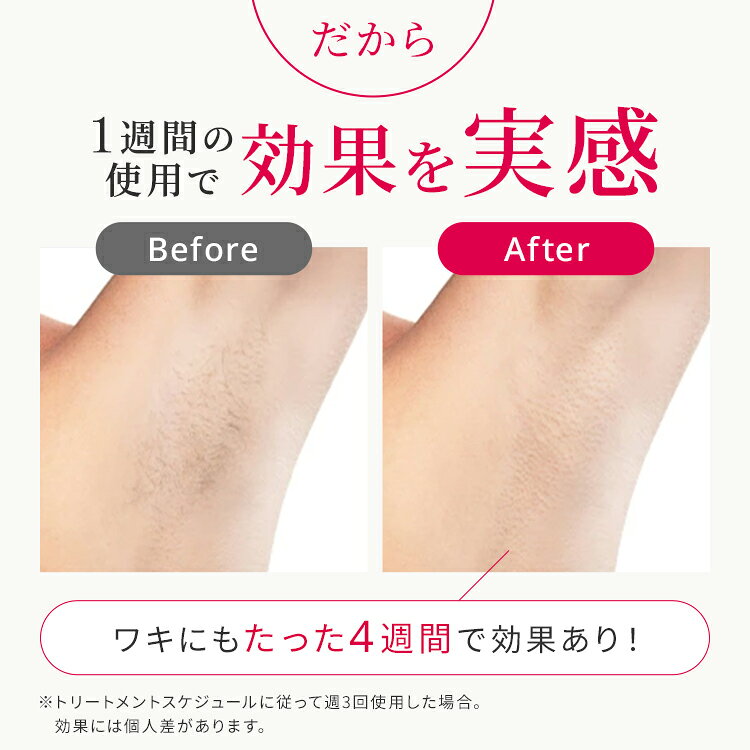 10/5・10/10はポイント5倍!【35%OFFクーポンで69,800円 → 45,370円+条件達成で合計3,000P!10/4〜10/11】<新発売> Ulike 公式 Air 10 Max IPL 光美容器 2026年モデル ユーライク 脱毛器 脱毛 サファイア美容器 冷却機能 USHRモード 顔 ワキ ヒゲ 自宅ケア 女性 男性 - メイン画像 19