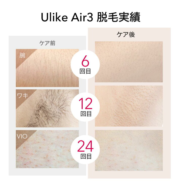 楽天市場】Ulike 公式 IPL 光脱毛器 Air3桜色 全身脱毛器 サファイア 