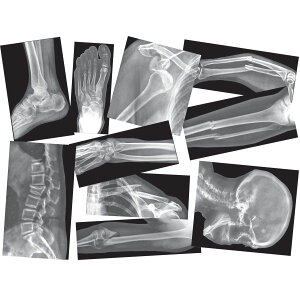 [] Roylco , RYLR5914, ܃gQZbg, 15/ [yVCOʔ] | Roylco, RYLR5914, Broken Bones x-rays Set, 15 / Box