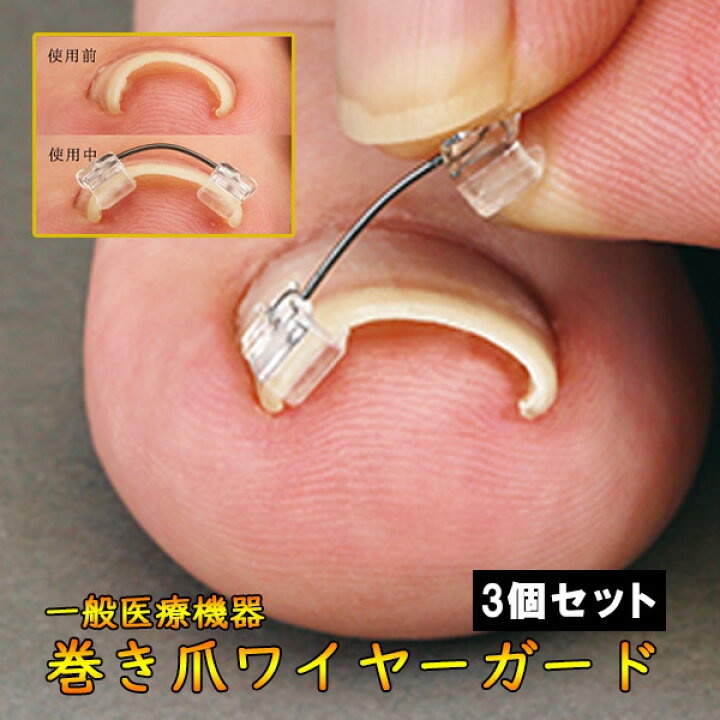 楽天市場】ワンダフルDAY【全品対象5%OFFクーポン】【P2倍】8/1 0:00~ 23:59迄 巻き爪 クリップ 巻きづめ ワイヤー 巻き爪 ワイヤー 巻き爪 セルフケア 一般医療機器 巻き爪ワイヤーガード 3個セット : 美活応援店 【 アットシュシュ 】 楽天市場】ワンダフルDAY【全品対象5%OFFクーポン】【P2倍】8/1 0:00~ 23:59迄 巻き爪 クリップ 巻きづめ ワイヤー 巻き爪 ワイヤー 巻き爪 セルフケア 一般医療機器 巻き爪ワイヤーガード 3個セット : 美活応援店 【 アットシュシュ 】