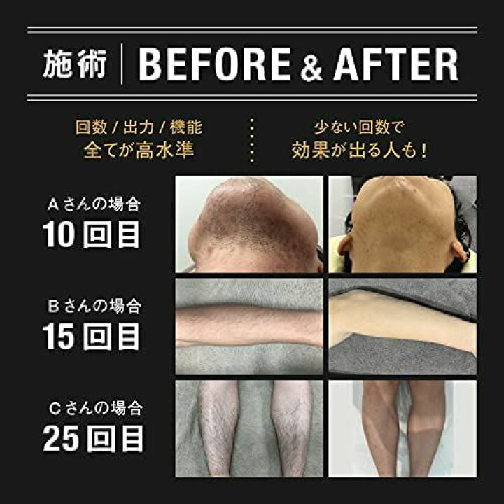 楽天市場】HOME CLEAR(ホームクリア) 脱毛器 メンズ 髭 顔 ワキ全身 
